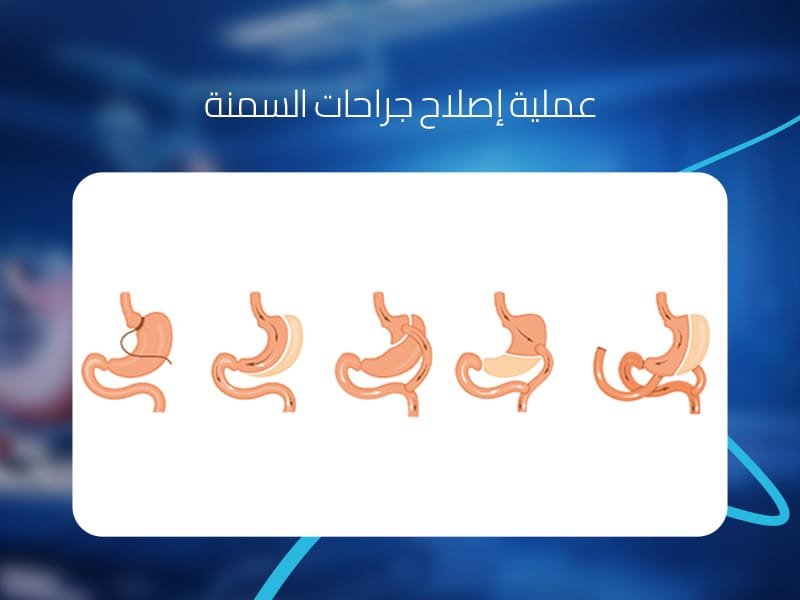 عملية إصلاح جراحات السمنة