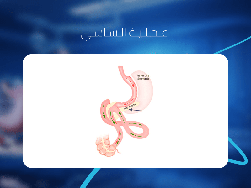 عملية-الساسي