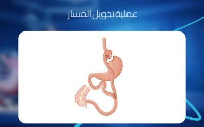 عملية تحويل المسار